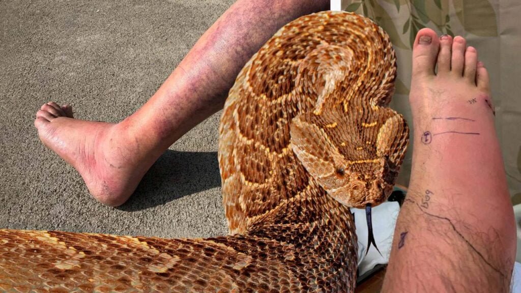 snake bite